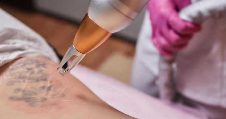 Everything You Should Know About Laser Tattoo Removal